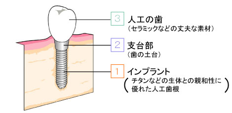 インプラントの構造