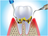 スケーリング（歯石・歯垢除去）